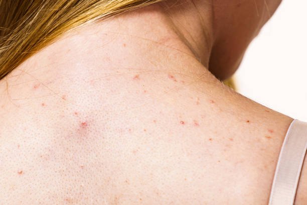 acne 1